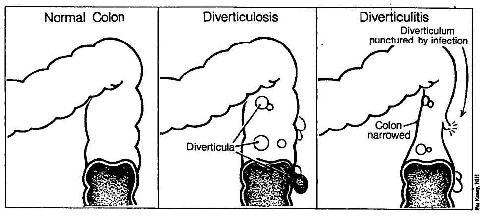 Best Diverticulitis Treatment